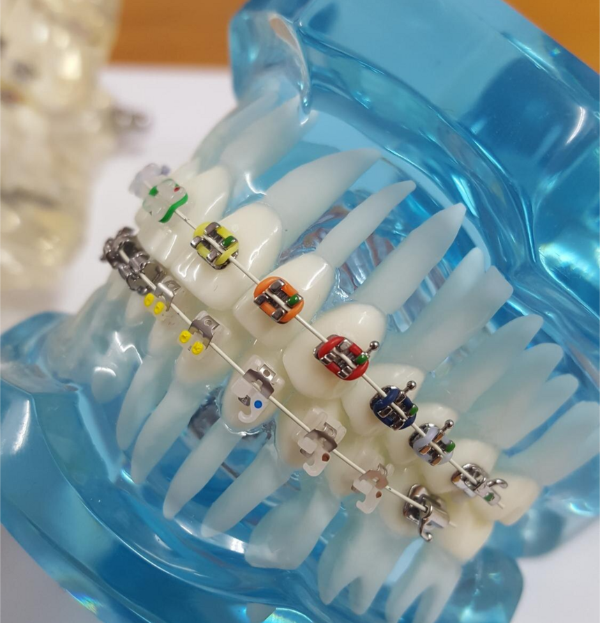 Dental Veneers in Indira Nagar Nashik