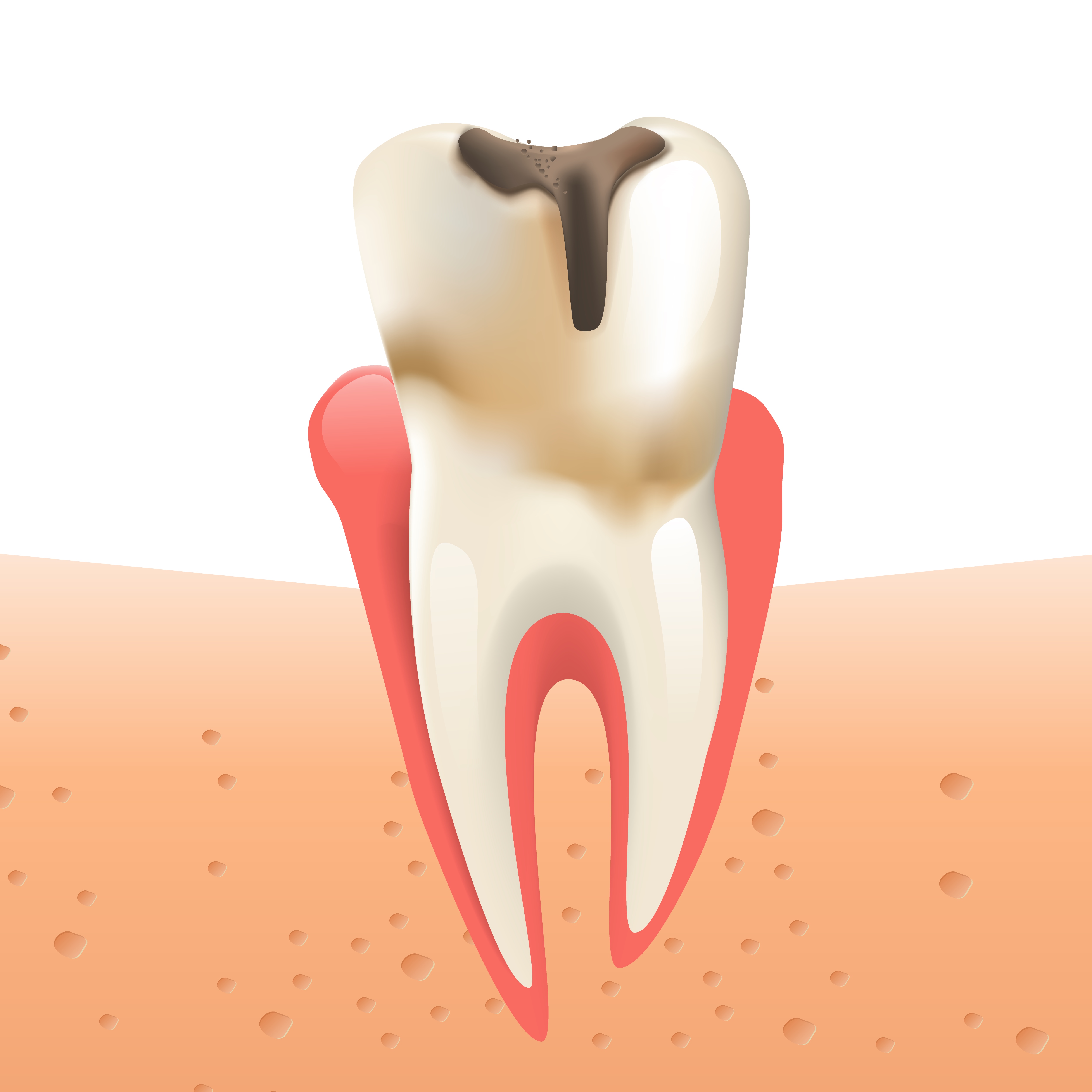 Root Canal in Indira Nagar Nashik